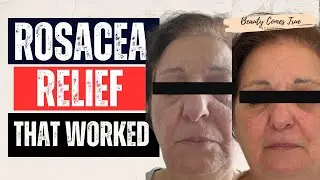 This helped with Rosacea & hyperpigmentation