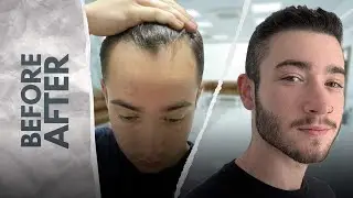 Male Norwood Type 2 Hair Loss | DHI Hair Transplant Results with 2000 Grafts | Heva Clinic
