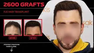 🔥 12 μήνες μετά: νέο hairline & εντυπωσιακή πυκνότητα με 2600 τριχοθυλάκια FUE ✨ case #424