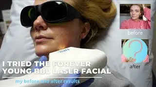 I TRIED THE FOREVER YOUNG BBL LASER FACIAL | HERE ARE MY RESULTS