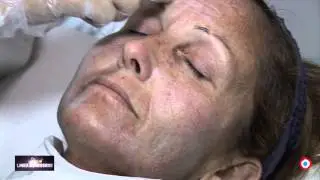Ore 17.00-OCCHIOTV: oggi parliamo del peeling chimico.