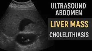 Finding of ultrasound abdomen!liver mass! Cholelithiasis!Fatty liver!#ultrasoundmadeeasy86#viral#uk 