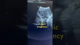 Ectopic pregnancy #ectopicpregnancy #uterus #ultrasound #obglife #pregnancy #ytshort#short#baby#yt