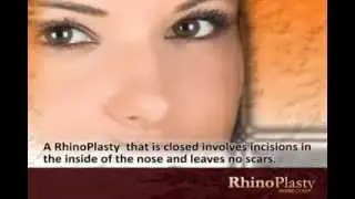 RhinoPlasty Guide #3