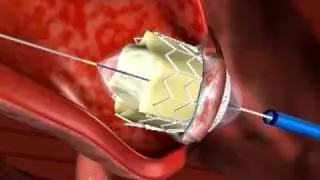 Trans-Apical Percutaneous Valve Animation