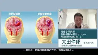The mutant origin of brain aneurysms and the first drug treatment