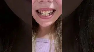 come get braces with me!!🦷| tags:🏷️ #fallaesthetic #ortho #grwm #braces #teeth #viralvideo