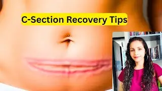 C Section Recovery Tips: पेट कम कैसे करें | Diet + Exercise After C Section
