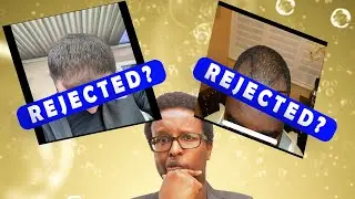 Why Are Clinics Rejecting Good Hair Transplant Candidates?