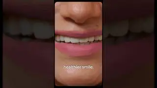 The Veneer 