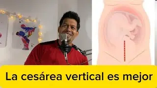 &iquest;CU&Aacute;L CESAREA ES MEJOR, LA VERTICAL O LA DE BIKINI?