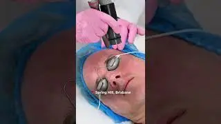 Sculptra Collagen Stimulation Therapy Brisbane | Restore Volume & Youthful Skin | Primavera Clinic