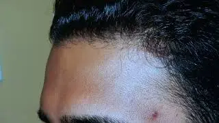 Side Profile Hair Transplant Transformation | FUE Hairline & Density Restoration by Dr. John Diep
