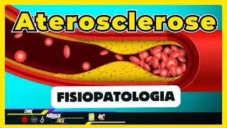 Aterosclerose: Patogenia; Fisiopatologia e tipos. [ Resumo Patologia 2024 ]