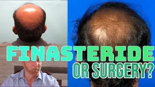 Finasteride vs. Surgery - Protecting your Hair Transplant Investment for the better Results