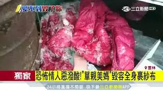 恐怖情人惡潑酸！「單親美媽」毀容全身裹紗布│三立新聞台