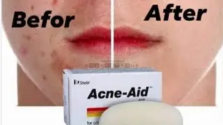 ব্রণ ও অয়েলি স্কিন থেকে মুক্তি | For Acne and oily skin | Acne aid Bar #acne #oilyskin