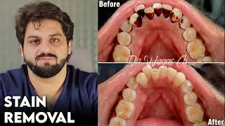 Stain Removal - Pan or Cigrattes Kay Dag  Khatam Karne Ka Tarika