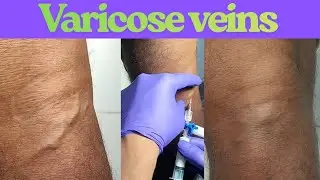 Foam Sclerotherapy treatment for varicose veins| Varicose veins treatment in Ranchi| Foam treatment