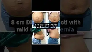 DiastasisRecti recovery story| Pooja Pandey Tripathi (PT): Arogya physiotips  #diastasisrecti