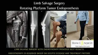 Treatment for Bone Cancer (Ewing's Sarcoma)-Limb Salvage Surgery, Tumor Prosthesis, Dr Srimanth BS