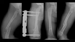 Fractura de fémur / Rehabilitación en casa
