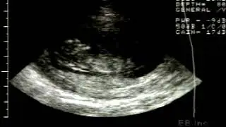 Chorionic Villus Biopsy