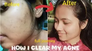 How I clear my acne 🤯|| Don't do❌ these mistakes ||full journey#acnejourney#acne #skincare #ytviral 