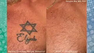 Safe & Effective Laser Tattoo Removal | Dr. Douglas Wu