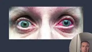 Monocular Vision Loss