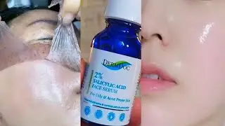 Dermdoc 2% salicylic acid serum for oily and acne prone skin honest review ||DermDoc serum