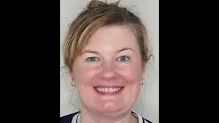 All-On-X Dental Implant Results - Glenferrie Dental