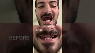 The Smile They Said Couldn&rsquo;t Happen | Complex Dental Implants at ClearChoice​