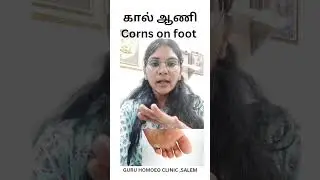 #கால்ஆணி#கால்ஆணிசெய்ய கூடாதது#Corns on feet explained in Tamil|How to remove corns on feet