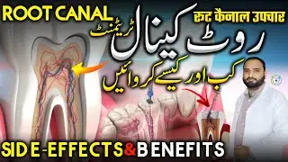 Root Canal Treatment | Is RCT safe, procedure,why fails,side-effects,Benefits | Dr Aqeel Maqsood