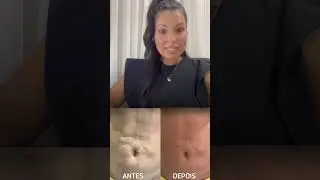 Fibrose tem tratamento sim! #fibrose #estetica #cirurgiapl&aacute;stica #fisioterapeuta #posoperatorio