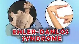 Elher Danlos Syndrome - flexible joints and stretchy, fragile skin