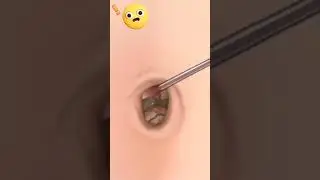 asrm belly naval removal game play 😶&zwj;🌫️