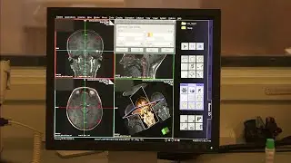 Brain imaging is critical even after mild head injuries