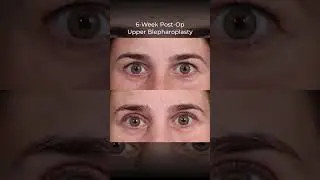 Upper Blepharoplasty Before & After | Dr. Paul Nassif