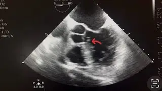 ? DISSECTION FLAP/ ? VEGETATION  MODERATE AR ON TEE