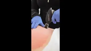 Fum&eacute;e pendant le soin OPUS ? On vous explique tout !
