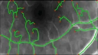 vessel centerline extraction based on distance transformations