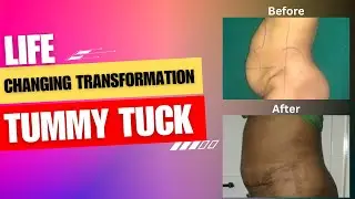 Life-Changing Tummy Tuck Surgery: A Patient&rsquo;s Journey to Confidence