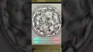 Клинический случай использования ионофора кальция. УЗИ в 32 года