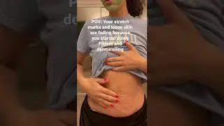 Getting rid of my stretch marks and loose skin 👀 #dermaroller #stretchmarks #postpartumbelly