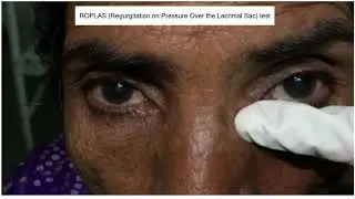 ROPLAS (Regurgitation on pressure over the lacrimal sac) test | ENT Lecture Series