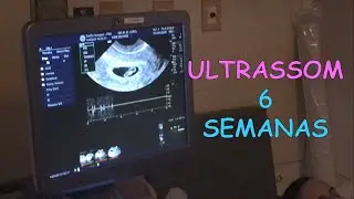 Ultrassom 6 Semanas de Gestação