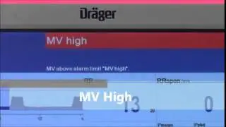 MV High Alarm in Drager Evita Infinity V500