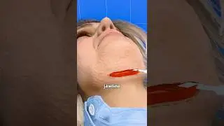 Что на самом деле происходит во время подтяжки лица! 👀